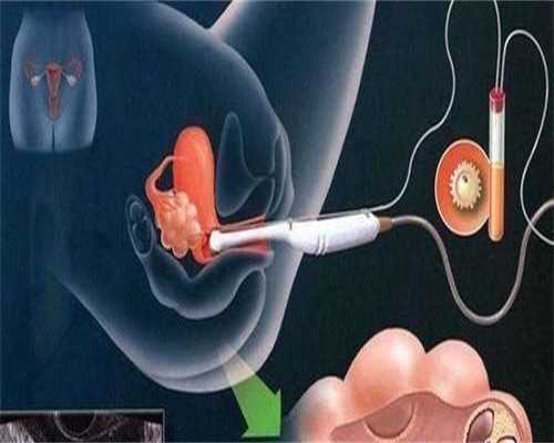 第一次移植失败第二次移植需要多少钱