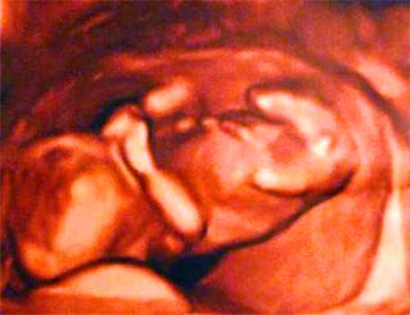 怀孕后，孕囊大小比胎芽小一周是怎么回事呢孕